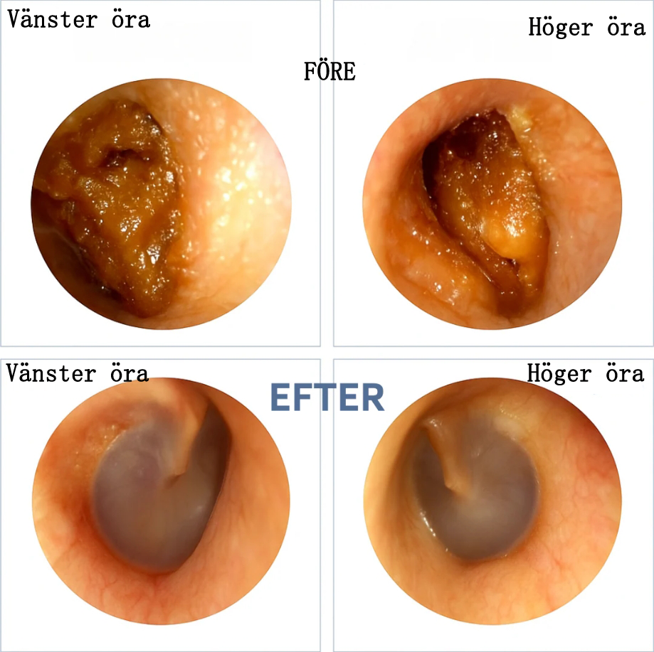 EASTADORES™ - Smart öronsköljare med avancerad teknik